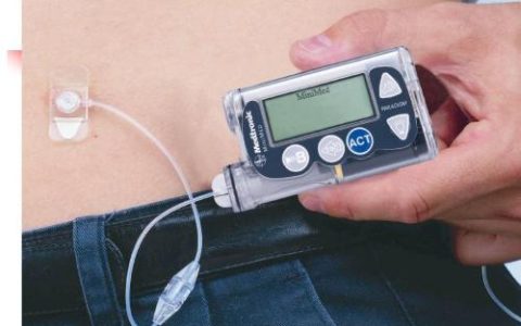 脆性糖尿病使用胰岛素泵获益更多