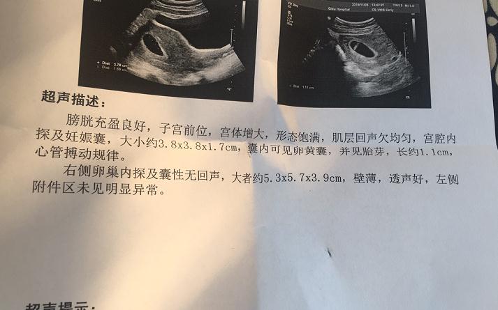 刚怀孕6周能不能查出胎儿性别,要查男女的宝妈们必须重视起来