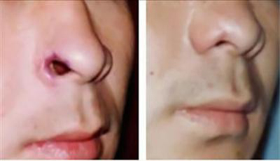 鼻孔整形医院排名_鼻孔整形真实案例_鼻孔整形让你摆脱猪鼻孔